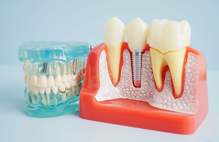 dental implants north york