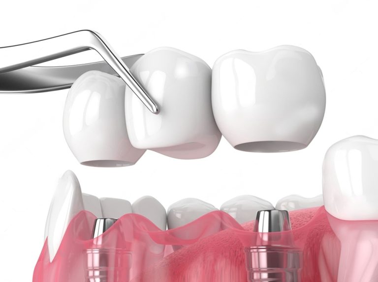 dental bridges