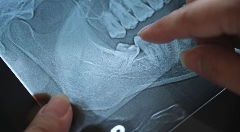 wisdom teeth removal north york