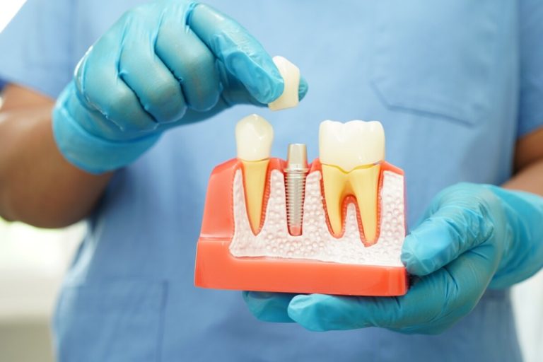 how a dentist in north york can save your tooth with root canal treatment