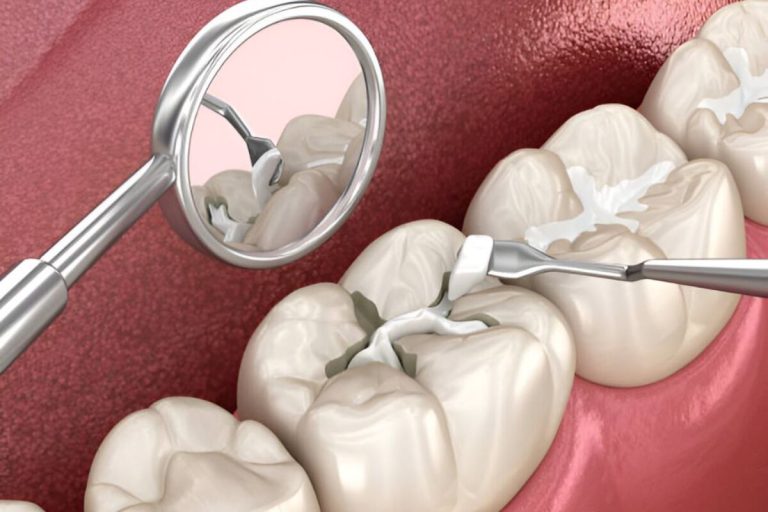 the importance of dental fillings for a healthy smile
